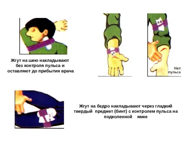 Кровоостанавливающий жгут время максимальное. Жгут на шею накладывают без контроля пульса. жгут на шею накладывают. наложение жгута на конечность на шею. наложение жгута на шею алгоритм.
