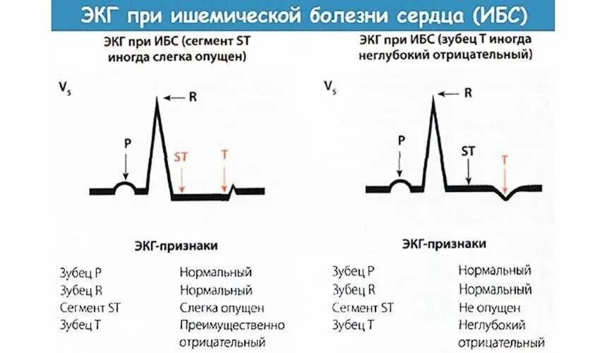 Умеренные неспецифические изменения. Сегмент St на ЭКГ В норме и патологии. Изменения на ЭКГ при ишемической болезни сердца. Двухфазный зубец т на ЭКГ. Ишемическая болезнь сердца ЭКГ признаки.