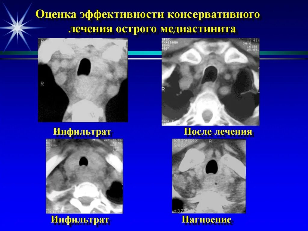 Медиастинит причины. Медиастинит рентген признаки. гнойный медиастинит рентген. фиброзирующий медиастинит. гнойный медиастинит симптомы.