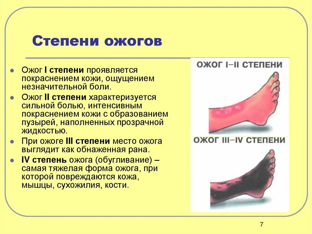 Ожоги обж 8 класс. Ожоги 1 степени характеристика первая помощь. Ожог 1 и 2 степени первая помощь. Характеристика ожогов , степень ожога. Степени термического ожога таблица.