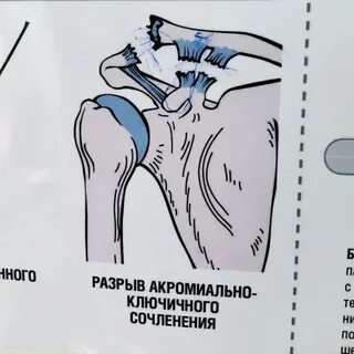 Разрыв акромиально ключичного сочленения