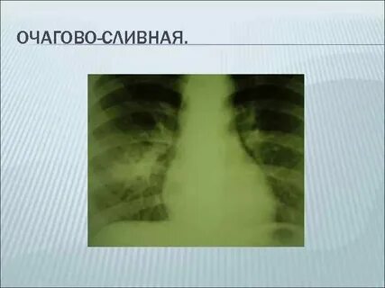 Сливная пневмония