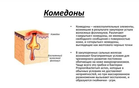 Закупорка фолликула
