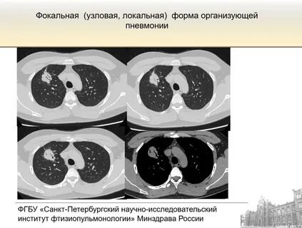 Организующаяся пневмония это