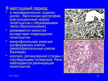 Дистрофия стромы