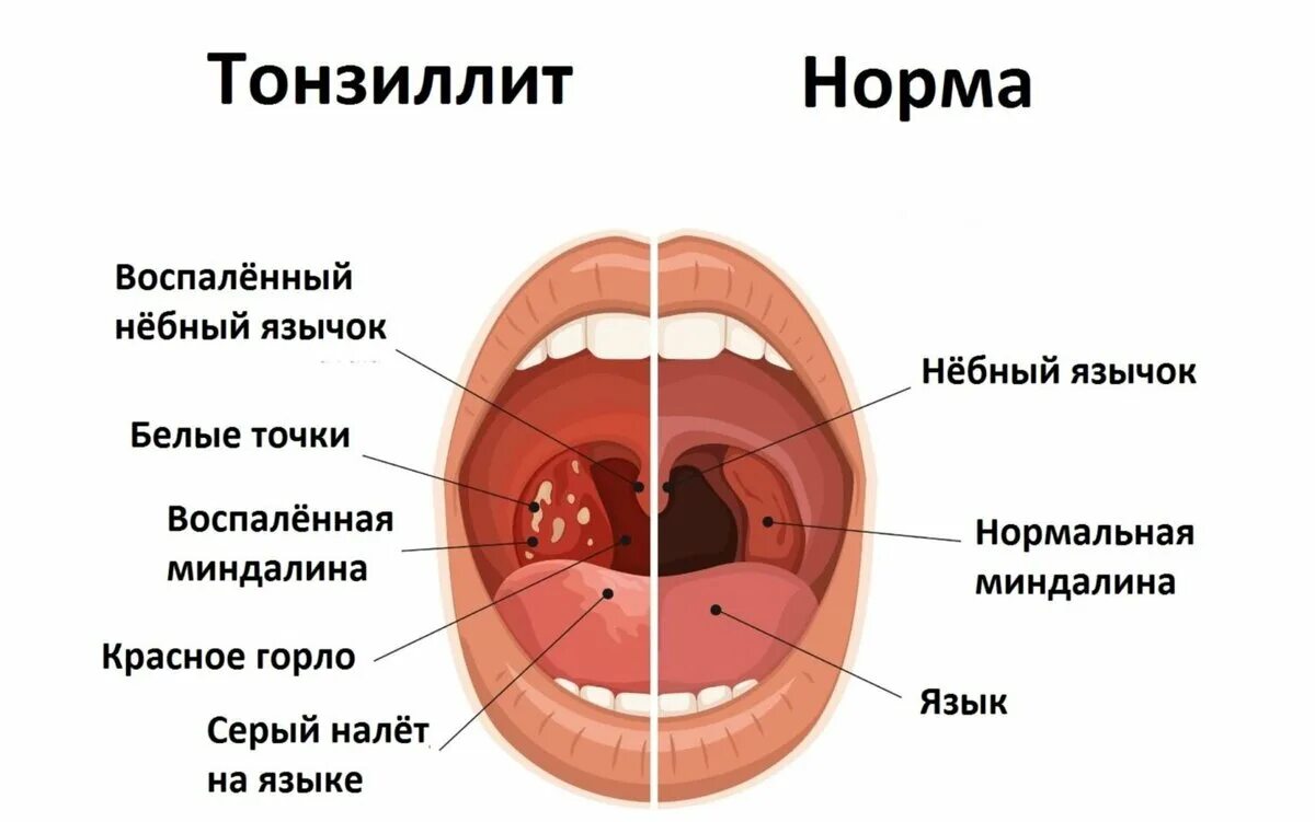 Тонзиллит вызывают бактерии. Тонзиллит острый тонзиллит.