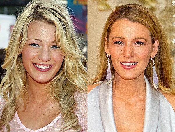 blake-lively-2014-2015 - Latest Plastic Surgery Gossip And News. Plastic Surgery