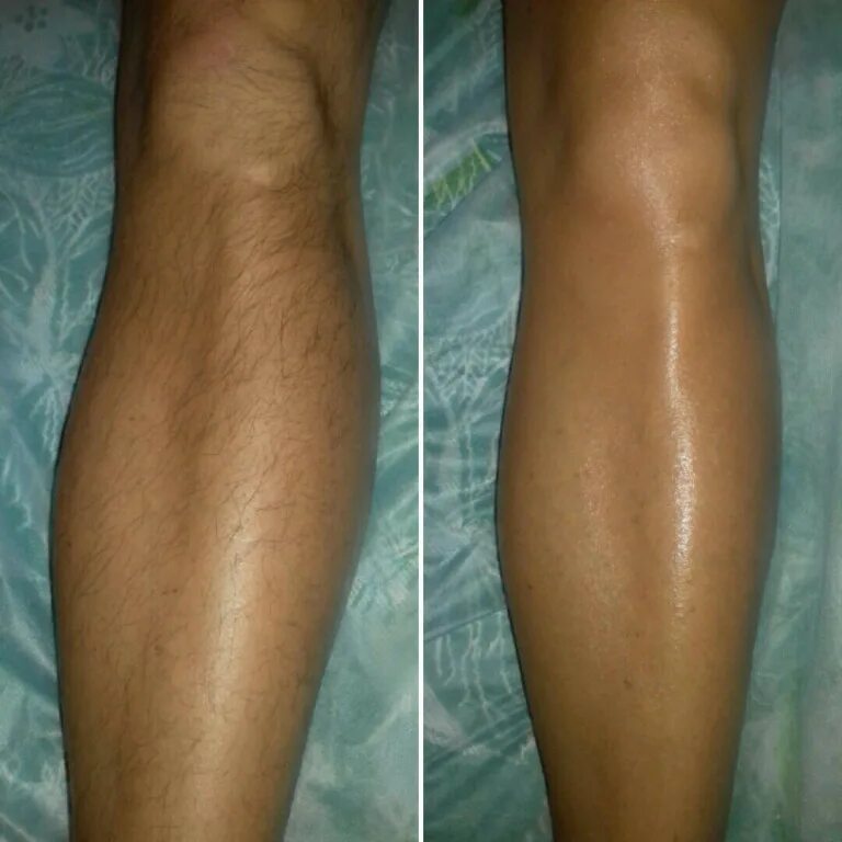 Эпиляция в новгороде. Бандажная техника восковой депиляции. Эпиляция в новгороде. Эпиляция ног. Шугаринг нижний новгород.