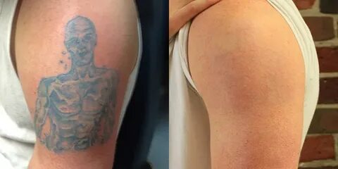 Сведенные Татуировки до и после