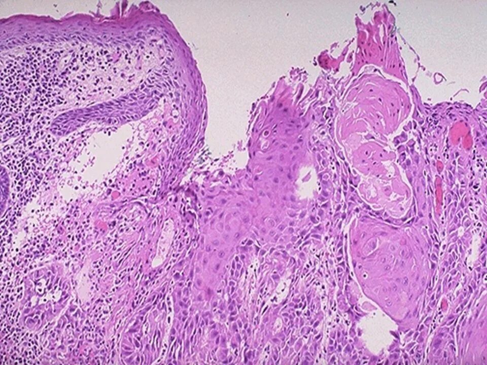 Squamous Cell carcinoma гистология. Плоскоклеточная карцинома легкого гистология. Бронхогенная карцинома гистология. Карцинома легкого гистология.