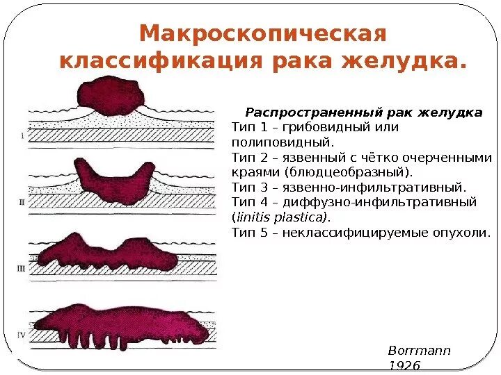 Диффузно инфильтративная. Классификация желудка. Язвенно-инфильтративная опухоль. Инфильтративные изменения желудка.