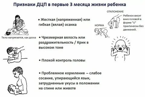 Признаки дцп у новорожденного в 1