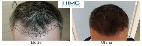 10 дней после пересадки