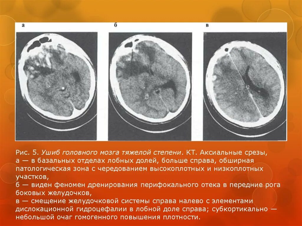 Ушиб головного мозга тяжелой степени. Ушиб головного мозга легкой степени. Ушиб головного мозга средней степени тяжести кт.