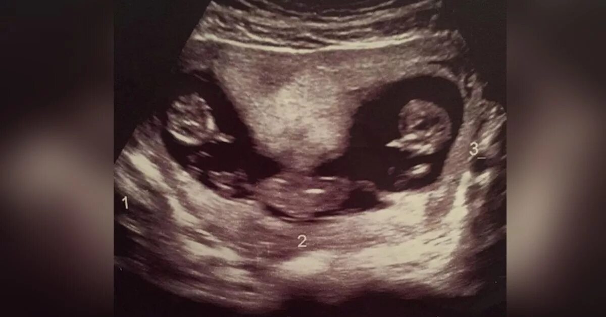 Узи 13 недель беременности двойня. Узи на 12 неделе беременности близнецы. Дихориальная диамниотическая двойня узи. Узи детей в животе 22 недели беременности двойня. Узи 13 недель беременности близнецы.