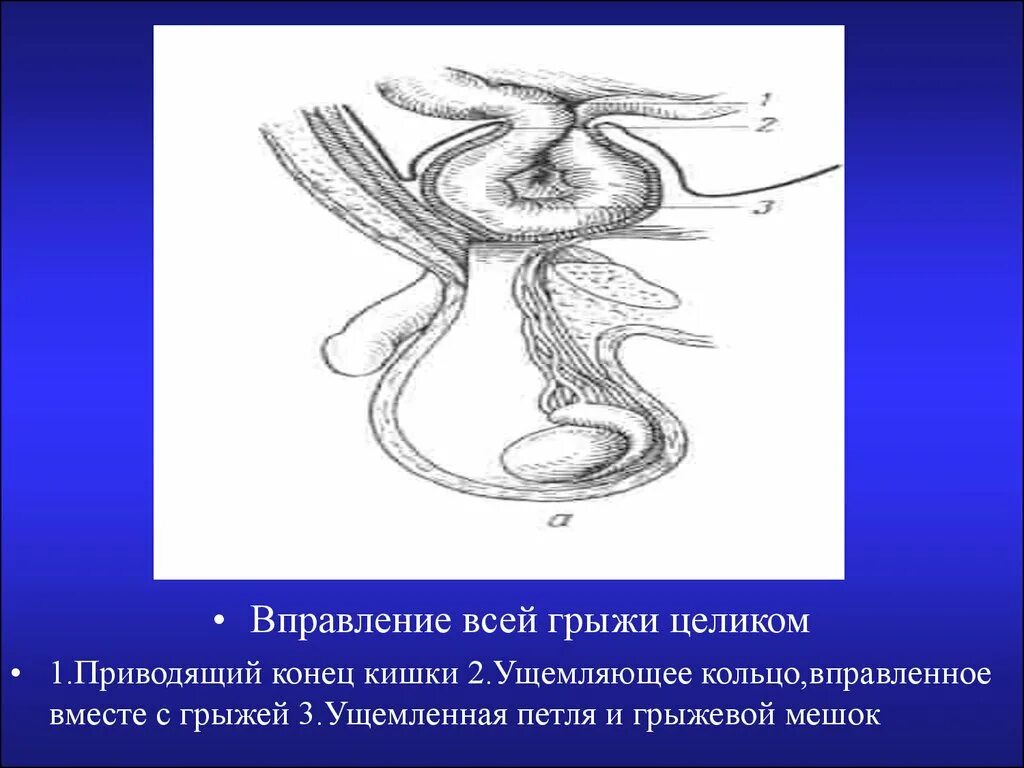 Ущемленная грыжа помощь. Ущемленная грыжа тактика хирурга. Ущемленная паховая грыжа тактика хирурга. Вправившаяся ущемленная грыжа. Вправление ущемленной грыжи тактика.