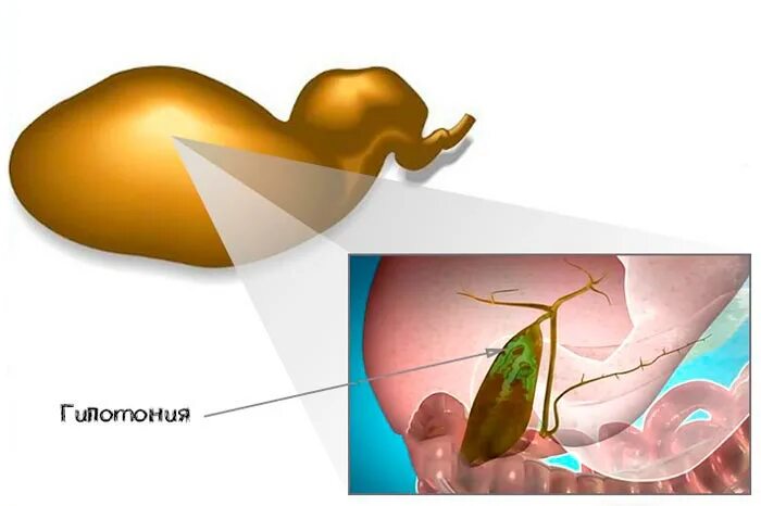 Желчном пузыре что бывает. Дискинезия желчевыводящих протоков. Мукоцеле желчного пузыря. ЖКБ камни желчного пузыря. Дискинезия желч. Путей.