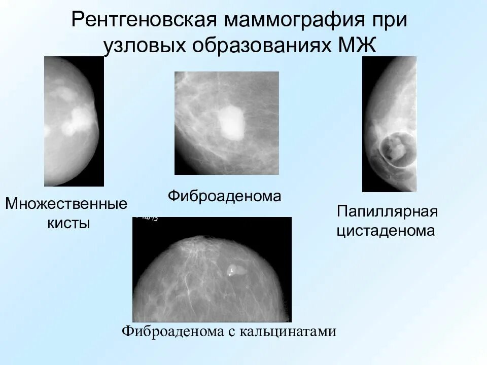 Образуют видимой формой. Рентгеновская маммография фиброаденомы молочной железы. Фиброаденоматоз рентген маммография. Фиброаденома молочной железы маммография. Обызвествленная фиброаденома молочной железы маммография.