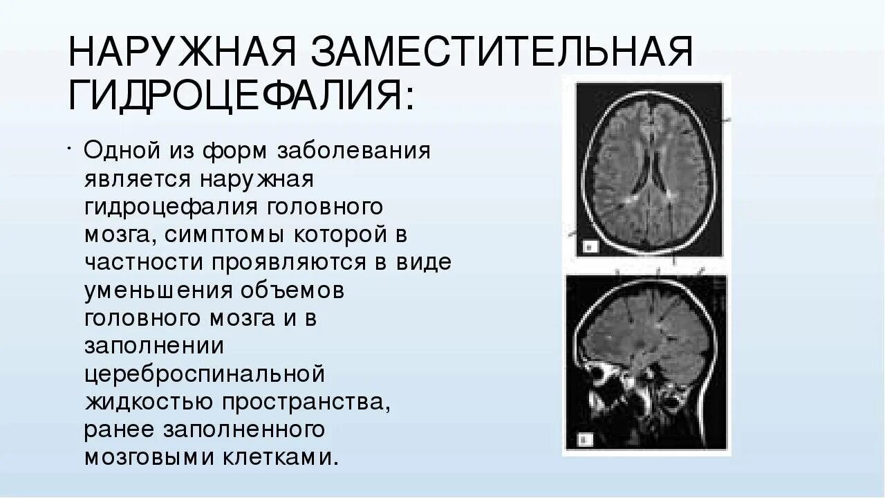 Умеренная атрофия мозга. Наружная гидроцефалия головного мозга мрт. Заместительная наружная гидроцефалия кт. Гидроцефалия головного мозга на кт. Наружная и внутренняя гидроцефалия головного мозга.