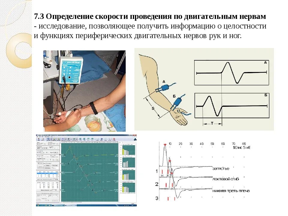 Метод измерения импульса. Определение скорости проведения возбуждения по нерву. скорость распространения возбуждения в периферических нервах. методы определения скорости распространения возбуждения по нервам. методика определения скорости проведения возбуждения по нервам..
