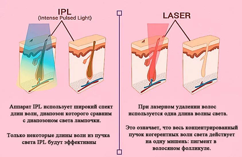 Чем отличается лазер. Принцип действия диодного лазера для эпиляции. Диодный лазер для эпиляции схема. Принцип действия лазерной эпиляции. Принцип работы лазерной эпиляции диодным.