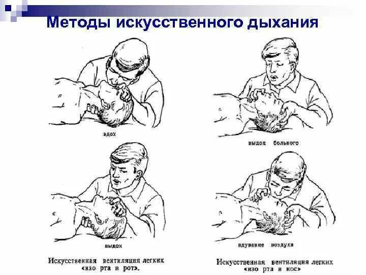 Алгоритм вентиляции легких искусственного дыхания. Схема приемов искусственного дыхания. Разновидности проведения искусственного дыхания кратко. Методика проведения искусственного дыхания рот в нос. Приемы искусственного дыхания