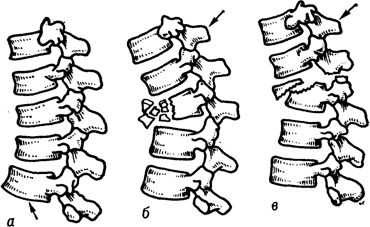 Повреждения позвоночника переломы. Компрессионный перелом тела л2 позвонка. Компрессионный перелом позвонков l3 l4. Компрессионный перелом позвоночника 1 степени. Компрессионный перелом позвоночника th-5-6.