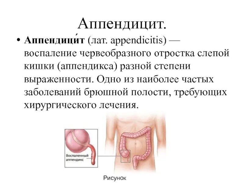 Строение кишечника аппендикс. Аппендикс у человека рудимент. Воспаленный аппендикс. Воспаление червеобразного отростка слепой кишки называется. Воспаление червеобразного отростка слепой кишки называется.