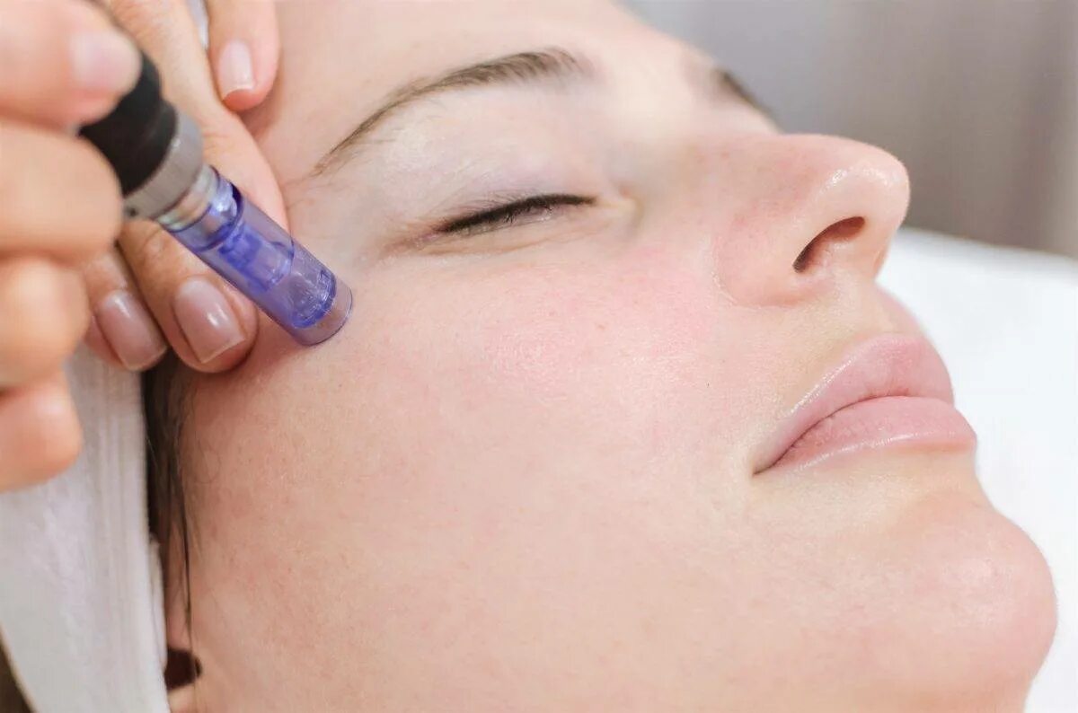 Дермапен пилинг. Фракционная мезотерапия (микронидлинг). мезотерапия dermapen. фракционная мезотерапия дермапен. микронидлинг дермапен.