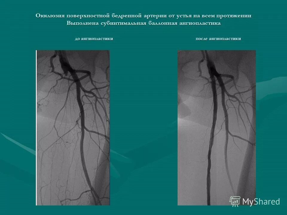 Окклюзия бедренно-подколенного сегмента. Атеросклероз бедренной артерии рентген. Атеросклероз, стеноз правой внутренней сонной артерии. Окклюзионные заболевания сосудов. Окклюзионные поражения периферических артерий.