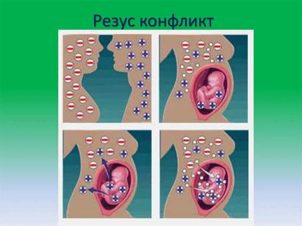 Несовместимость крови матери и плода. Резус конфликт. Резус-конфликт при беременности. Резус конфликт плода. Конфликт резус факторов.