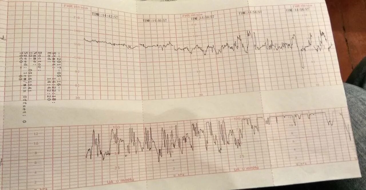 КТГ при беременности 2 схватки. КТГ при родовой деятельности. Схватки на КТГ при родах. Показатели КТГ при родах. Схватки на 30 неделе