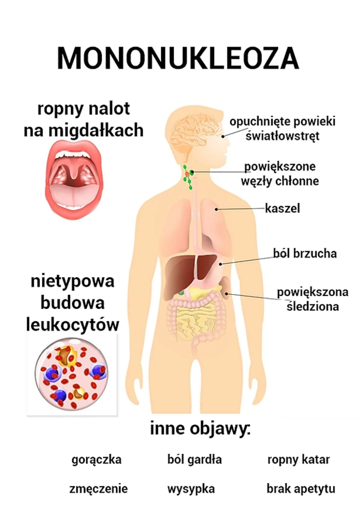 Мононуклеоз у взрослых что это за болезнь. Мононуклеоз.[21. Инфекционный мононуклеоз симптомы. Инфекционный мононуклеоз симптомы сыпь. Экзантемный мононуклеоз.