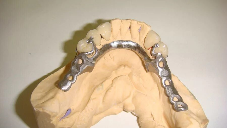 Каркас бюгельного протеза на нижнюю челюсть. Бюгельный протез замковый (2 замка Bredent). Бюгельный протез кламмера Роуча. Бюгельный протез с кламмерами Роуча. Бюгельное лабораторный этап