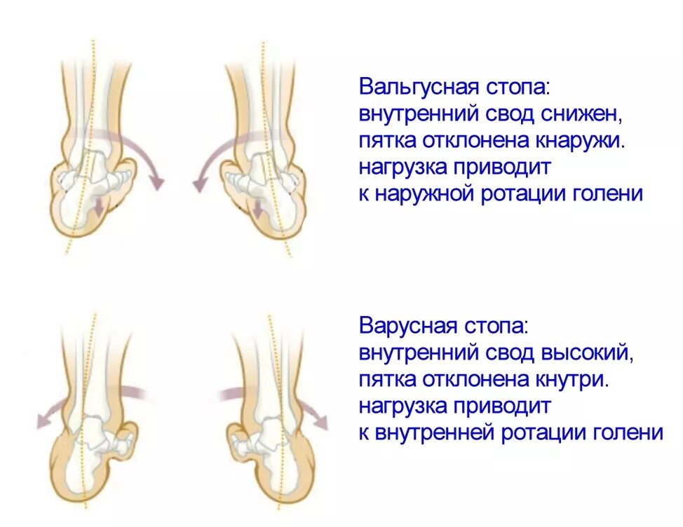 Заваливается стопа при ходьбе