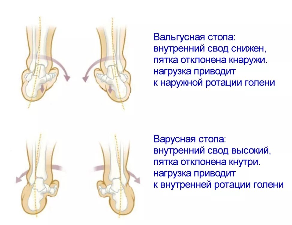 Плоско-вальгусная и эквино-варусная стопы. Вальгус и Варус стопы у ребенка. Вальгус и Варус стопы плоскостопие. Варусная деформация стопы у младенца. Вальгусная операция отзывы