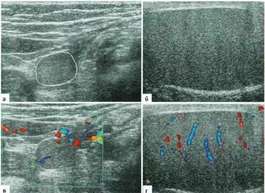 Крипторхизм гистология. УЗИ мошонки крипторхизм.