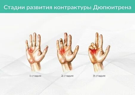 Лечение контрактуры