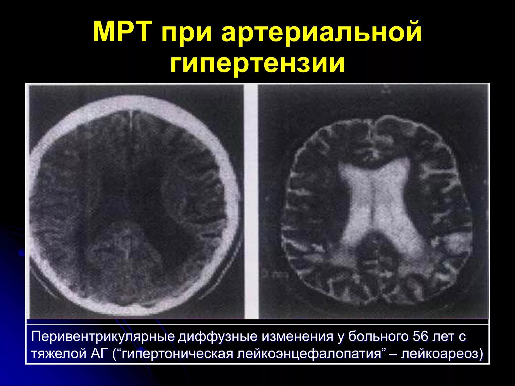 Диффузные нарушения мозга. Гипертензивная энцефалопатия мрт. Острая гипертоническая энцефалопатия мрт. Острая гипертензивная энцефалопатия кт. Мрт при острой гипертонической энцефалопатии.