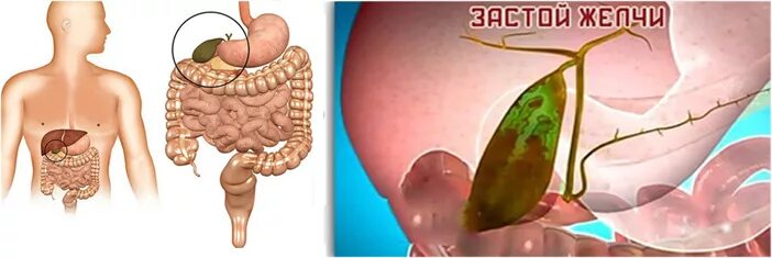 Желчь попадает в кишечник. Застойная желчь в желчном пузыре. Стаз желчи в желчном пузыре. Застой желчи в желчном пузыре симптомы. Застотой желчи в желчном пузырь.