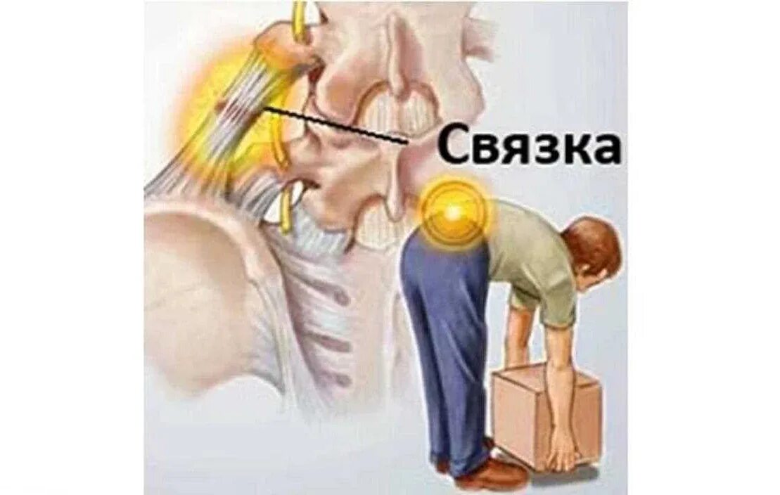 Сорвал спину. Сорвал спину боль в спине. связки спины.
