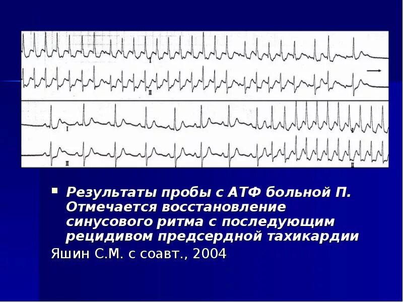 Ритм предсердий у ребенка. Нарушения ритма у детей. нарушение сердечного ритма у детей. аритмия сердца презентация. нарушения ритма сердца презентация.