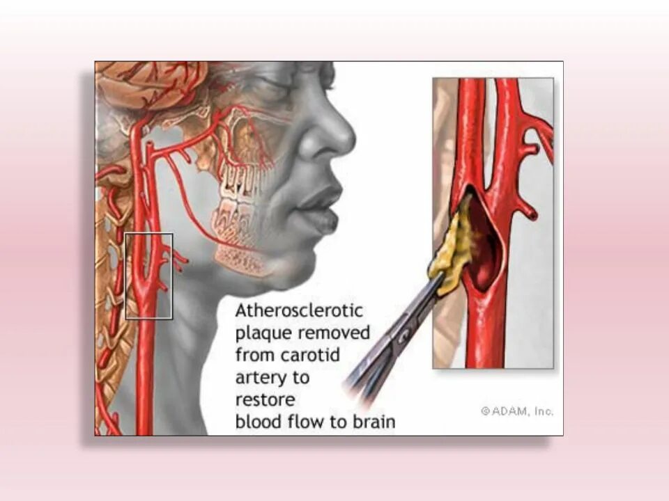 Эндартерэктомия атеросклероз. Операция каротидная эндартерэктомия. Каротидный синус сонной артерии. Сосуды каротидного синуса. Бляшка на шее операция