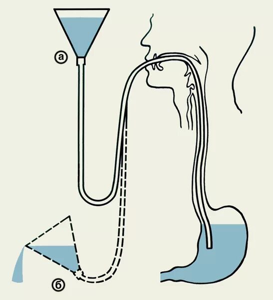 Промывание желудка при помощи желудочного зонда. Промывание желудка зондом алгоритм. Промывание желудка толстым зондом ребенку. Промывание желудка зондовым методом. Промывание желудка зондом алгоритм.