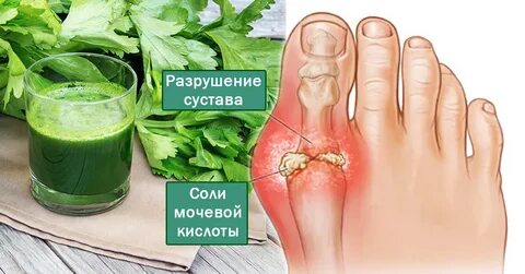 Средство от мочевой кислоты в суставах