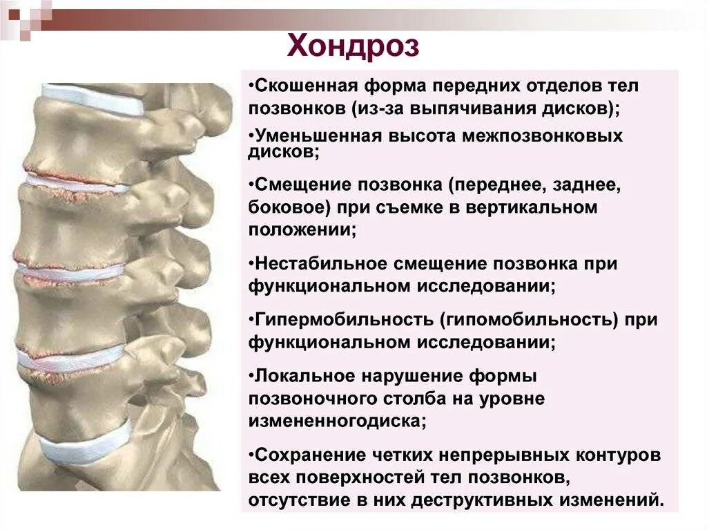 Как вылечит позвонки