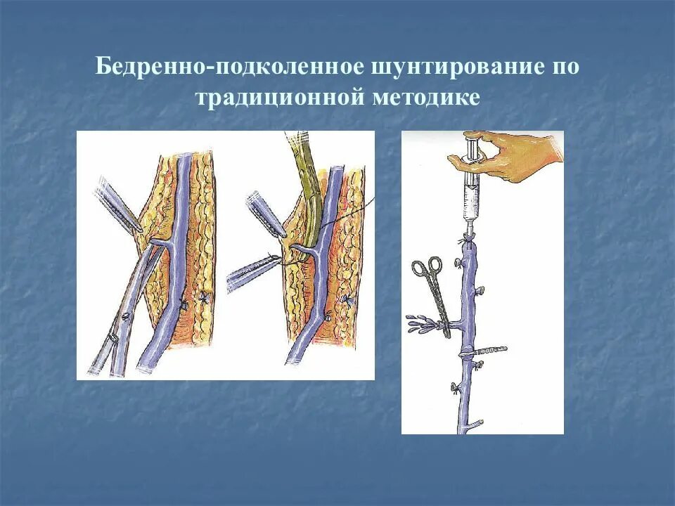 Бежренно-бедоенное шунтирование. Проксимальное бедренно подколенное шунтирование. Подколенно-тибиальное шунтирование. Операция бедренно подколенное шунтирование.