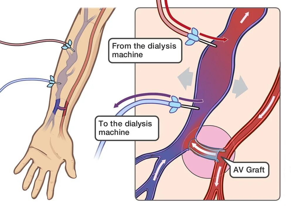 Фистула. Артериовенозная фистула диализ. Фистула гемодиализ схема.