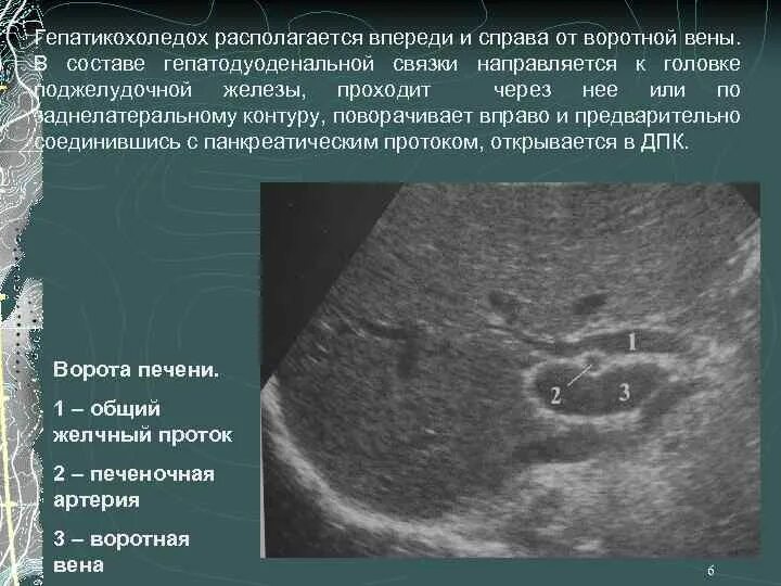 Лимфоузлы ворот печени. Печеночно дуоденальная связка кт. Печеночно двенадцатиперстной связки УЗИ. Печеночно-двенадцатиперстная связка на УЗИ. Диссекция гепатодуоденальной связки.