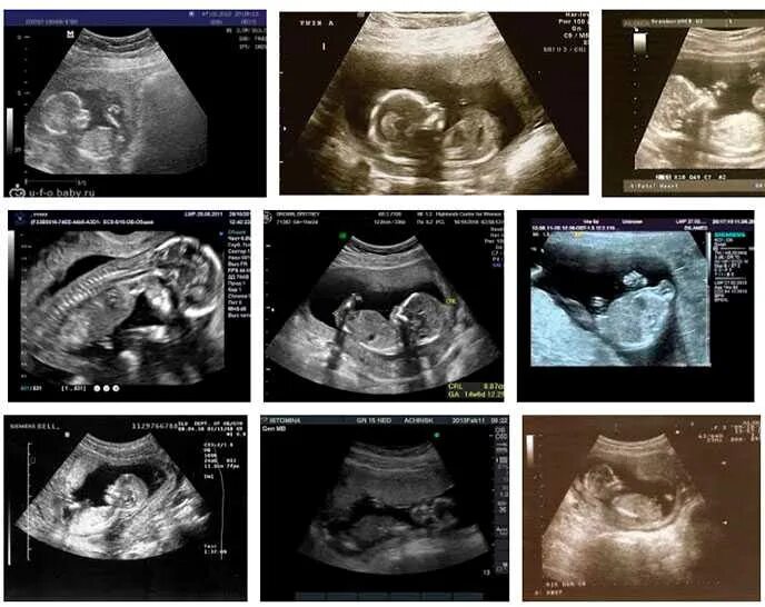 15 недель развитие. 15 Недель беременности фото плода на УЗИ. УЗИ плода на 15 неделе беременности. Малыш на 15 неделе беременности УЗИ. Плод 15 недель беременности размер плода.